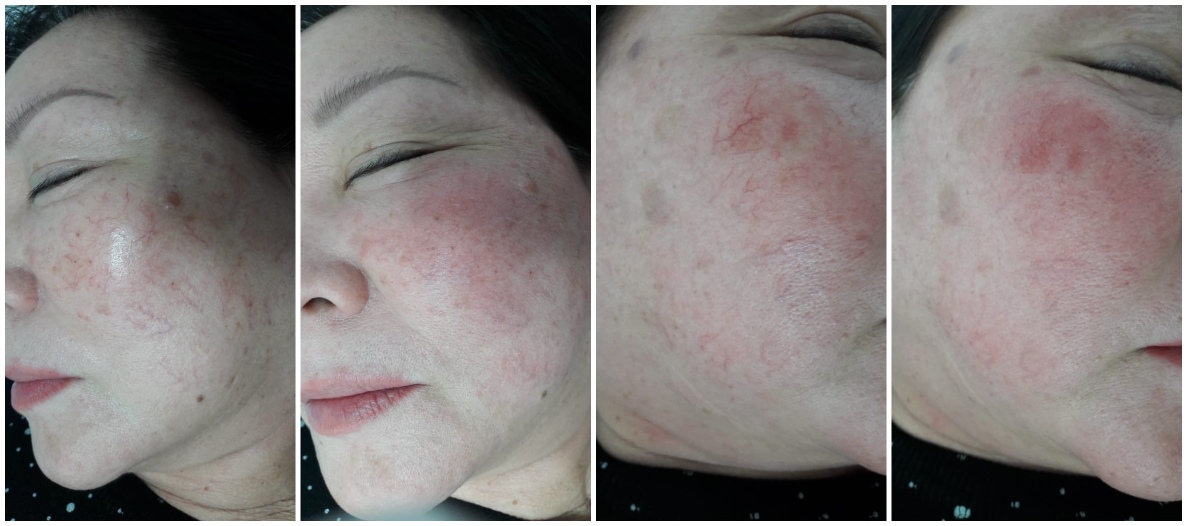 আগে এবং পরে শিরা অপসারণ