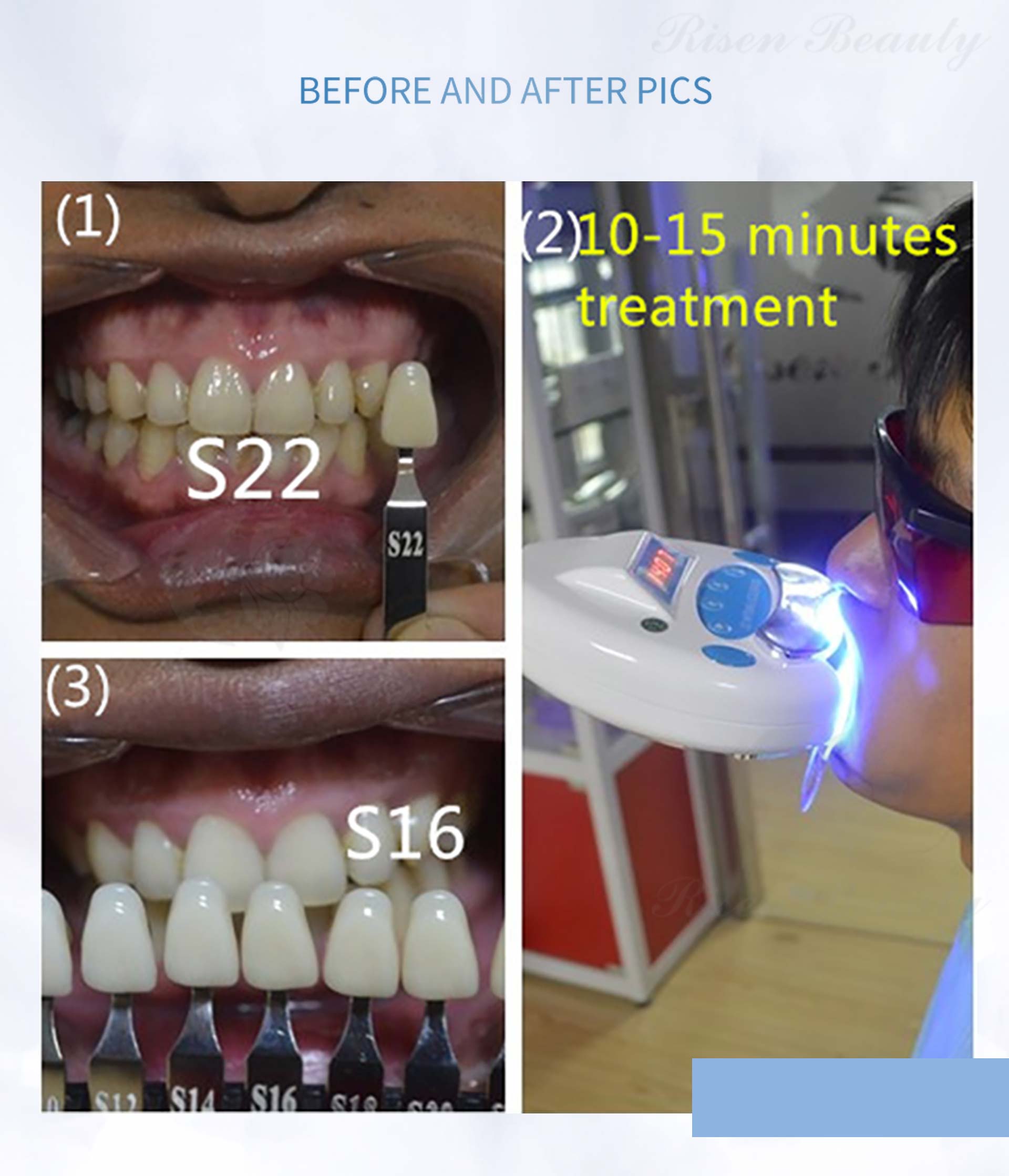 dantų balinimo aparatas